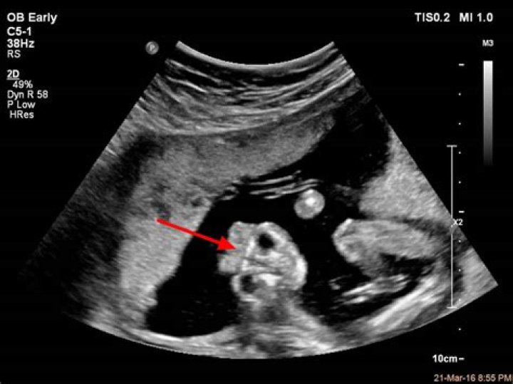 Anencephaly