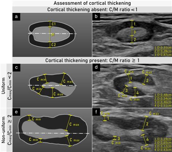 Features on Ultrasound
