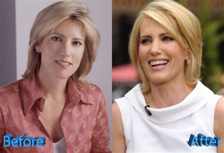 Laura Ingraham's Plastic Surgery Journey