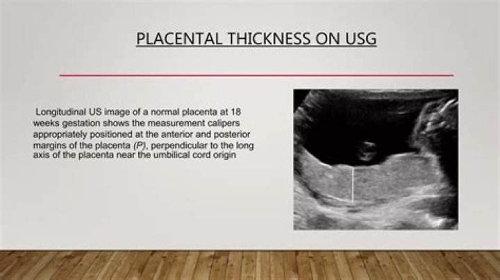 Measurement of Location of Placenta